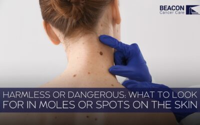 Harmless or Dangerous? What to Look For in Moles or Spots on the Skin